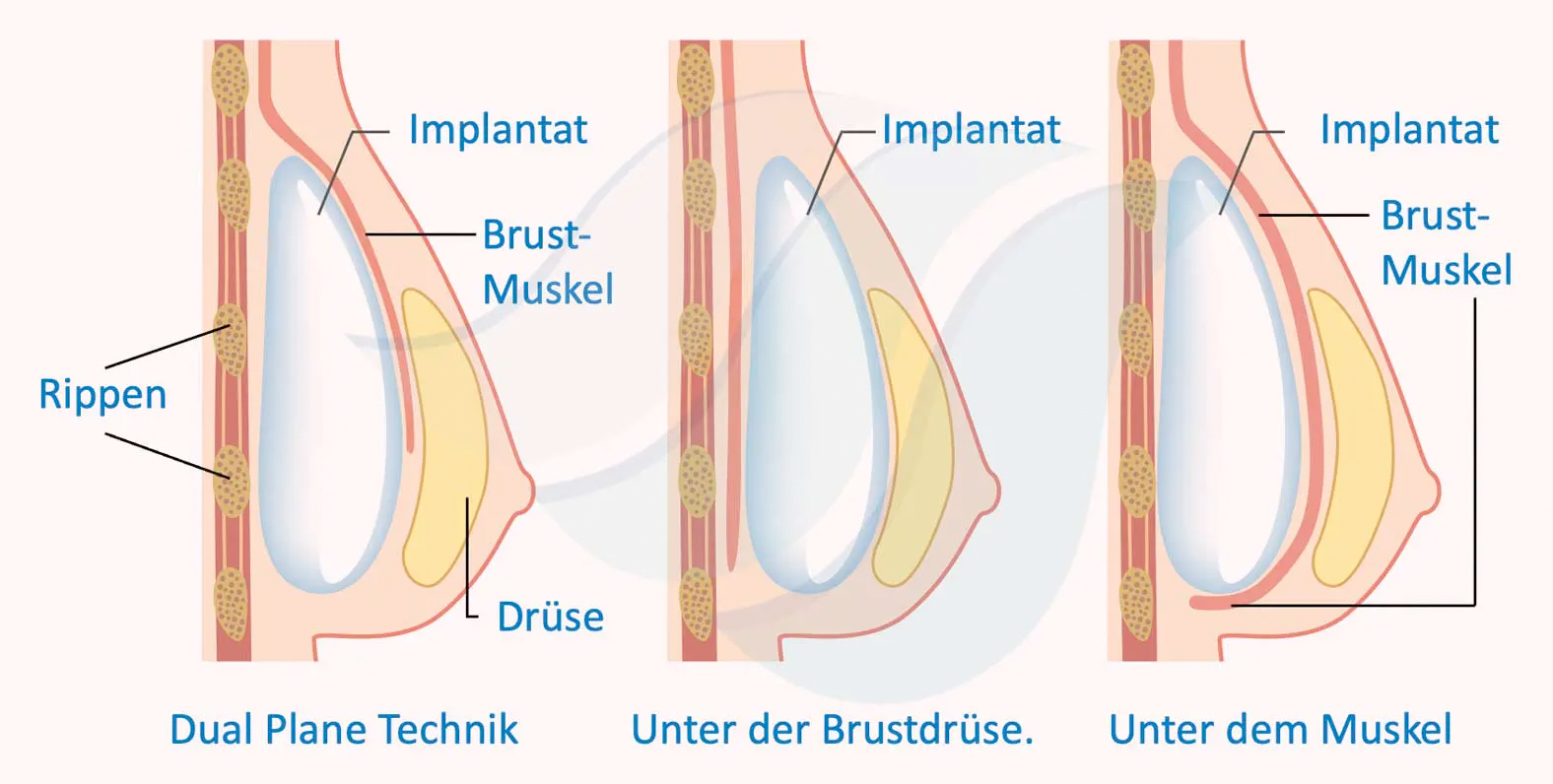 Position des Implantates